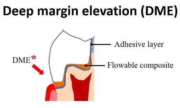 Step 5: Deep Margin Elevation