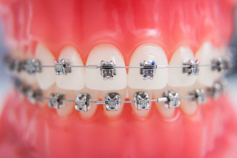 Conventional Ceramic Braces