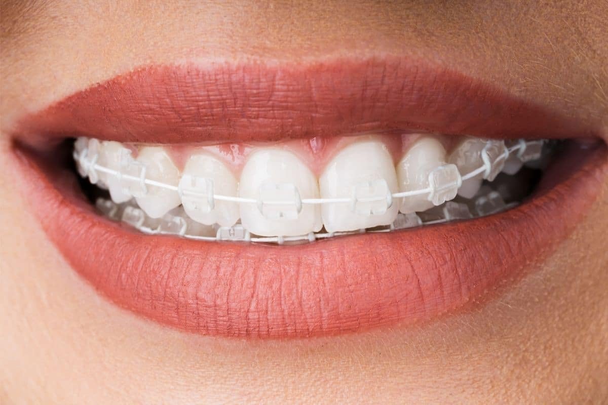 Self-Ligating metal Braces