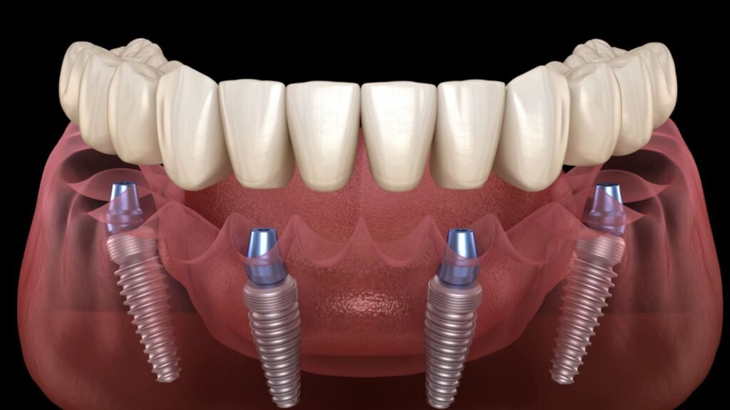 All-on-Four Implant-Supported Fixed Prosthesis