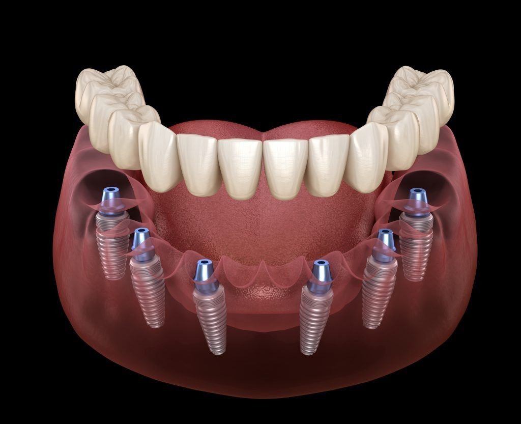 All on six implant supported fixed prosthesis
