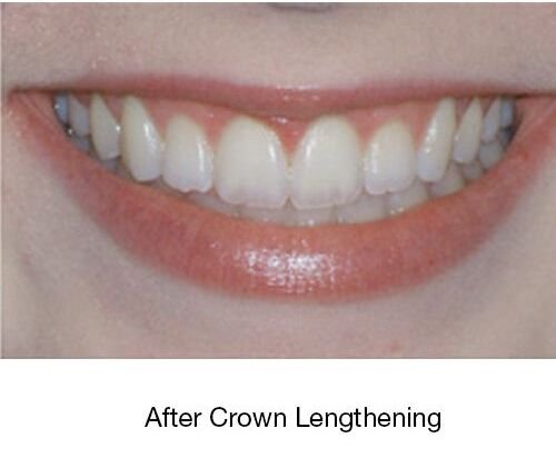 After Crown Lengthening