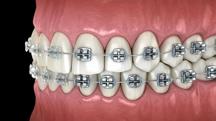 Orthodontic treatment options