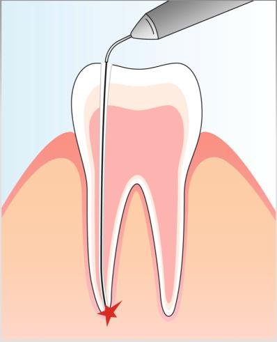 Laser Root Canal Disinfection