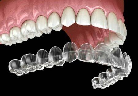 Clear aligners treatment