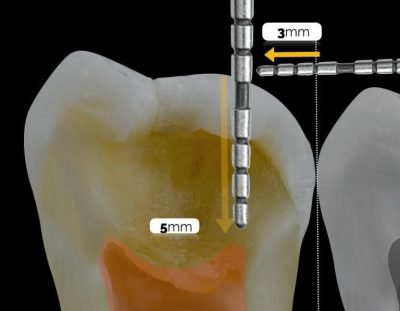 Step 2: Selective Caries Removal