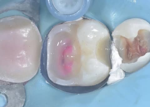 Step 4: Immediate Dentin Sealing
