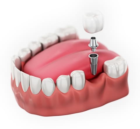 Single Tooth Implant