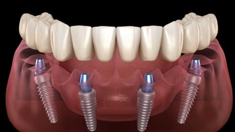 All-on-Four Implant-Supported Fixed Prosthesis