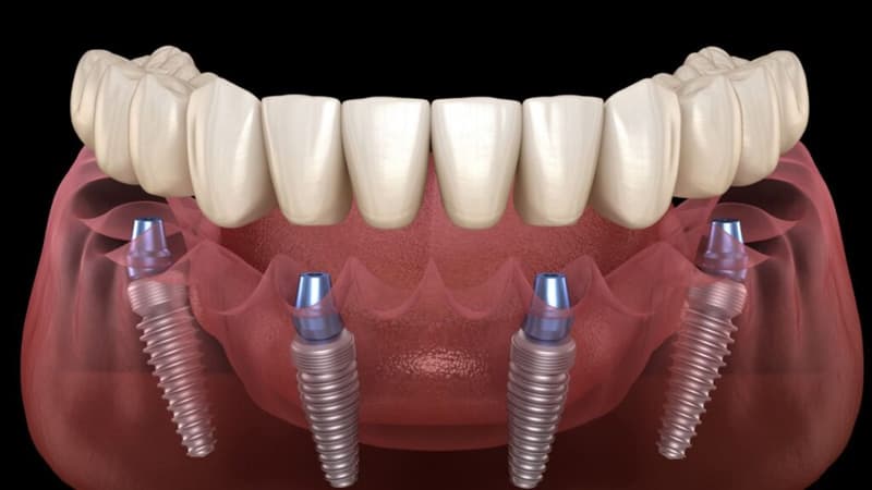 All-on-4 dental implants – four implants supporting a fixed full-arch bridge