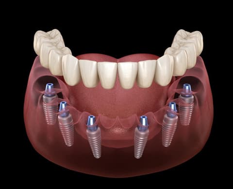 All on six implant supported fixed prosthesis