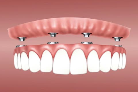 Implant-Supported Removable Overdentures