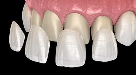 Smile Makeover Veneers and Crowns