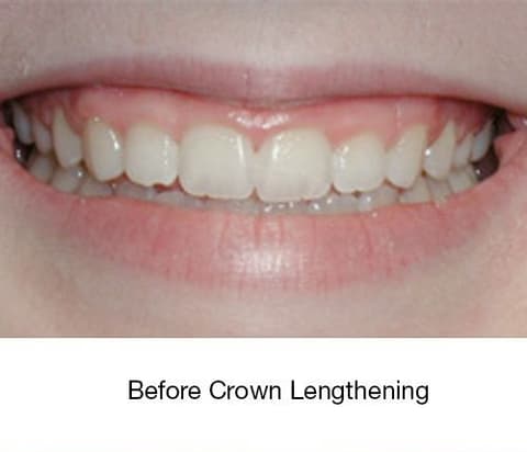 Before Crown Lengthening