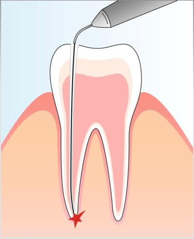 Laser Root Canal Disinfection