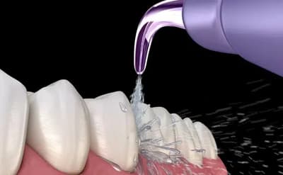 Biomimetic dentistry treatment