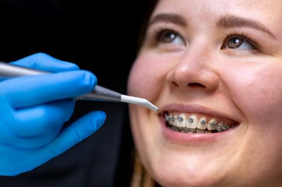 Braces versus clear aligners comparison