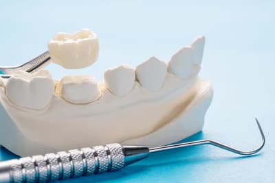 Dental crown and bridge model