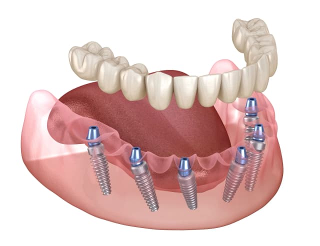 Dental implant treatment planning