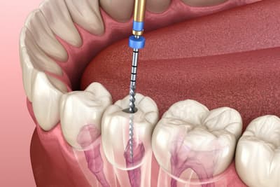 Early signs of root canal infection