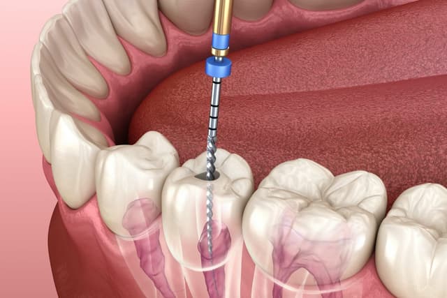 Early signs of root canal infection