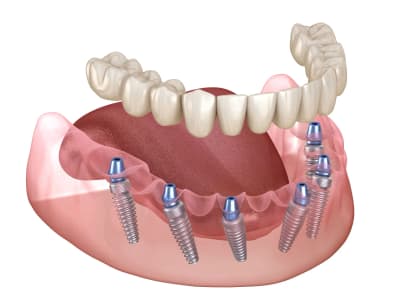 Implant-supported full arch illustration