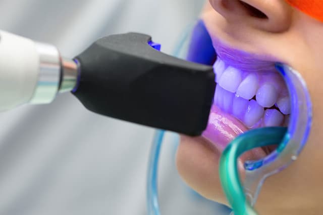 Laser teeth whitening treatment