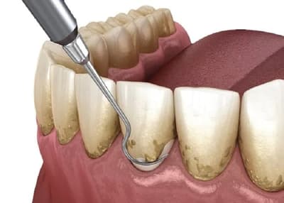 Professional teeth cleaning and dental checkup