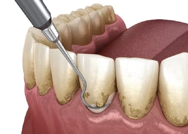 Professional teeth cleaning and dental checkup