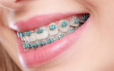 Close-up of orthodontic braces