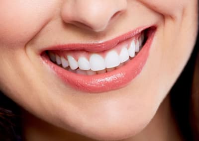 A natural, bright smile after cosmetic treatment