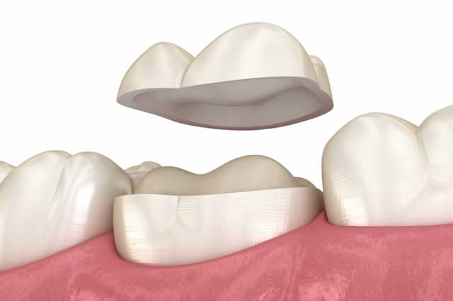 Tooth sensitivity to cold